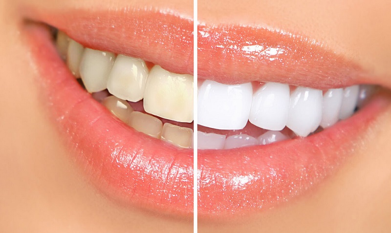 Что же такое отбеливание зубов Zoom-4?